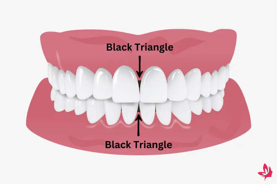 black triangle teeth home remedy