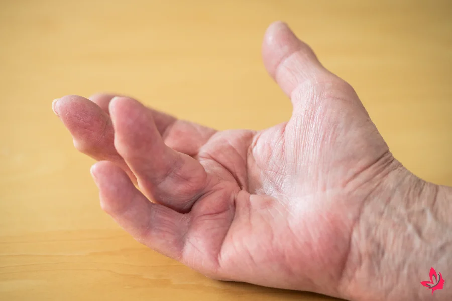 home remedies for lump in palm of hand