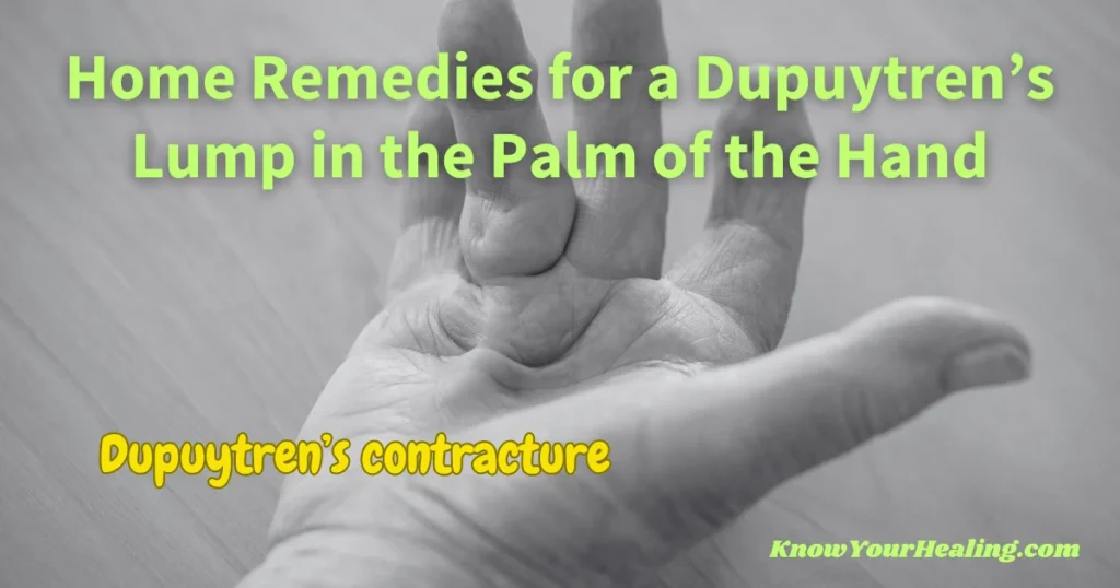 home remedies for lump in palm of hand