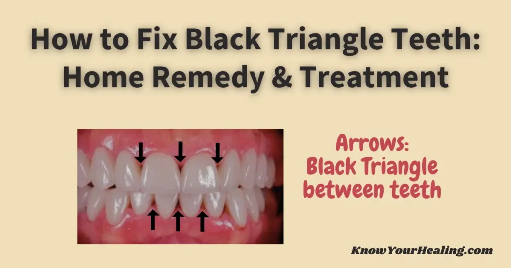 black triangle teeth home remedy