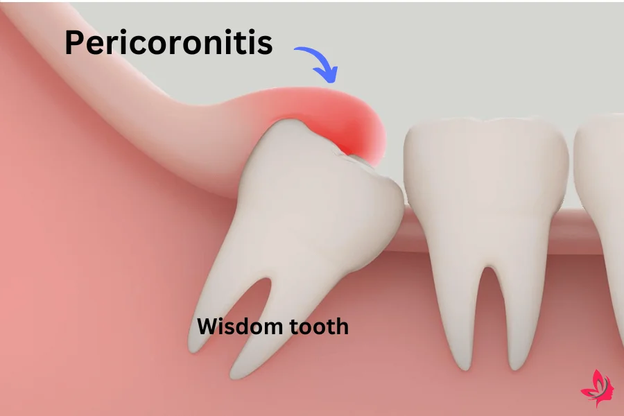 Pericoronitis home remedies