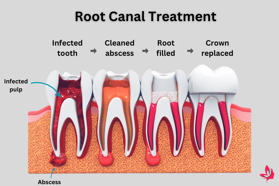 home remedy for root canal pain